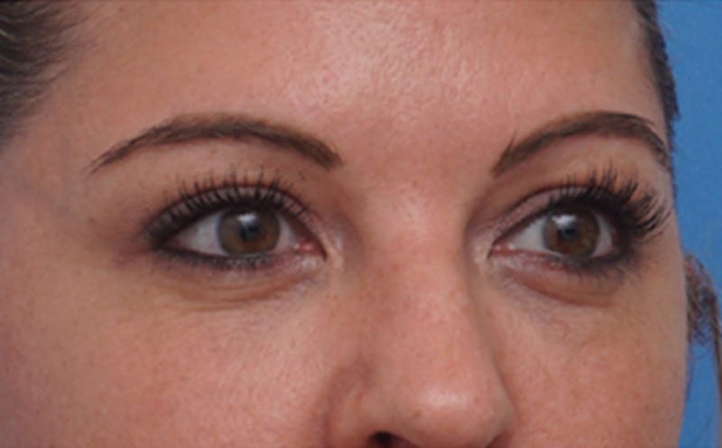 BOTOX Before & After Gallery - Patient 349427 - Image 6