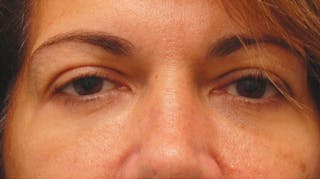Fillers Before & After Gallery - Patient 229636 - Image 2