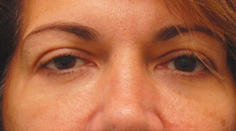 Fillers Before & After Gallery - Patient 229636 - Image 2