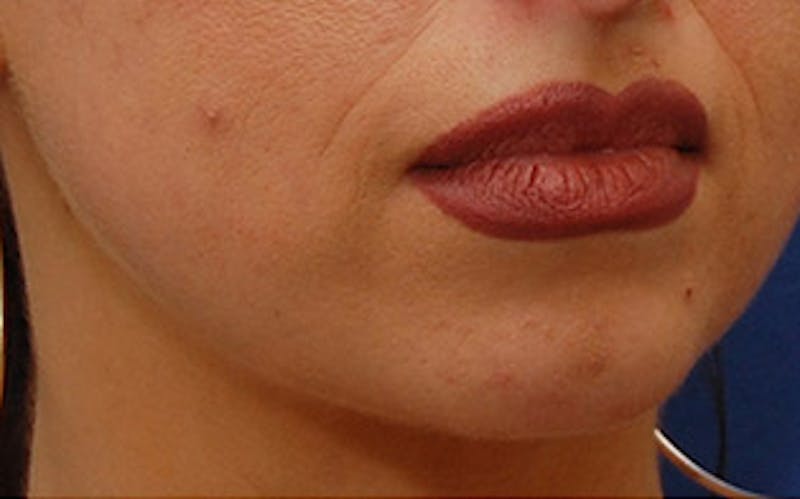 Chin Surgery Before & After Gallery - Patient 765705 - Image 3