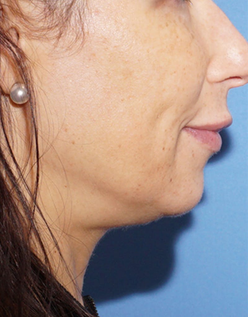 Patient dRybGXViSnOGcz_qDGdDXw - Jawline Contouring Before & After Photos