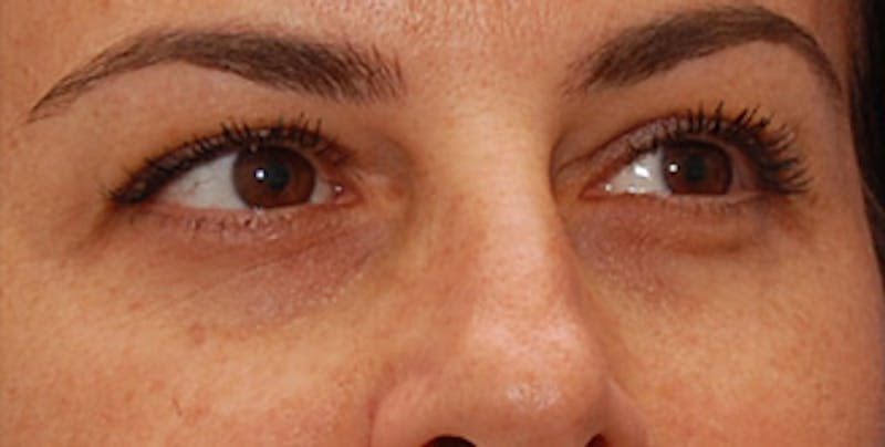 Eyelid Surgery Before & After Gallery - Patient 289046 - Image 3