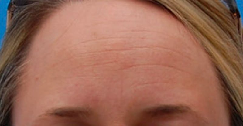 BOTOX Before & After Gallery - Patient 401532 - Image 1