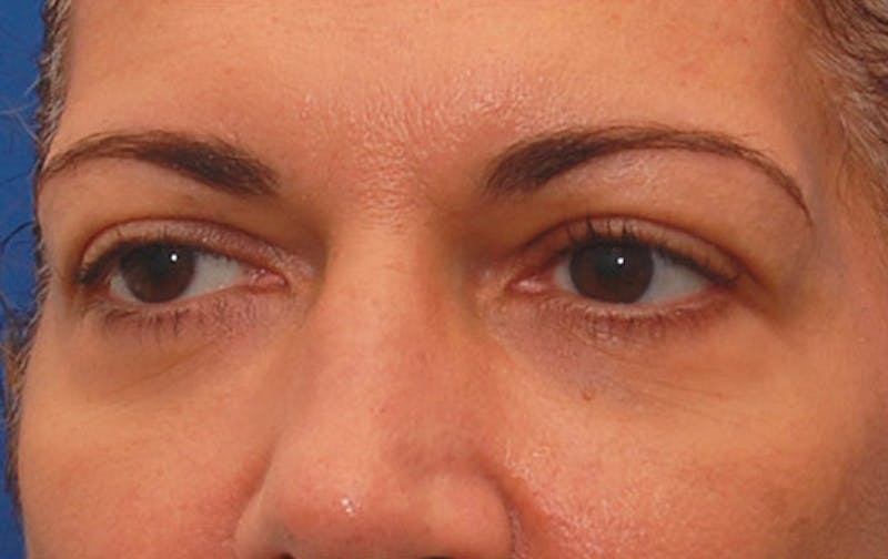 Fillers Before & After Gallery - Patient 229636 - Image 3