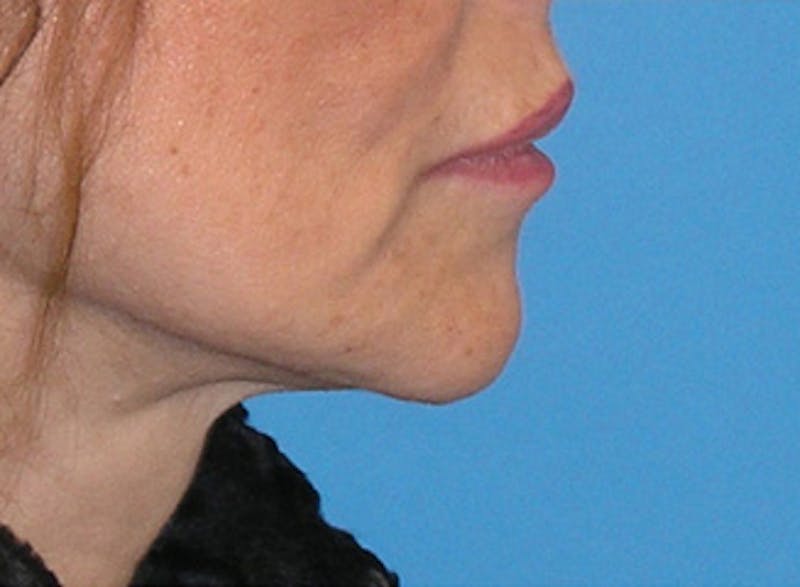 Patient M88c_9QnSa-4YZLuZLEqmg - Mini Facelift Before & After Photos