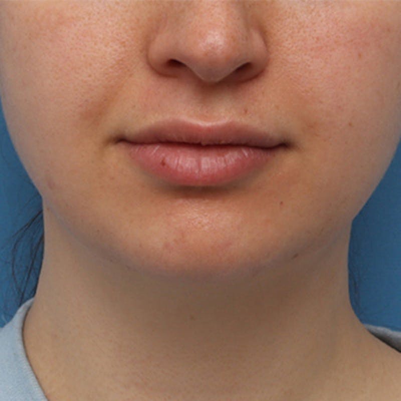 FaceTite Before & After Gallery - Patient 427549 - Image 1