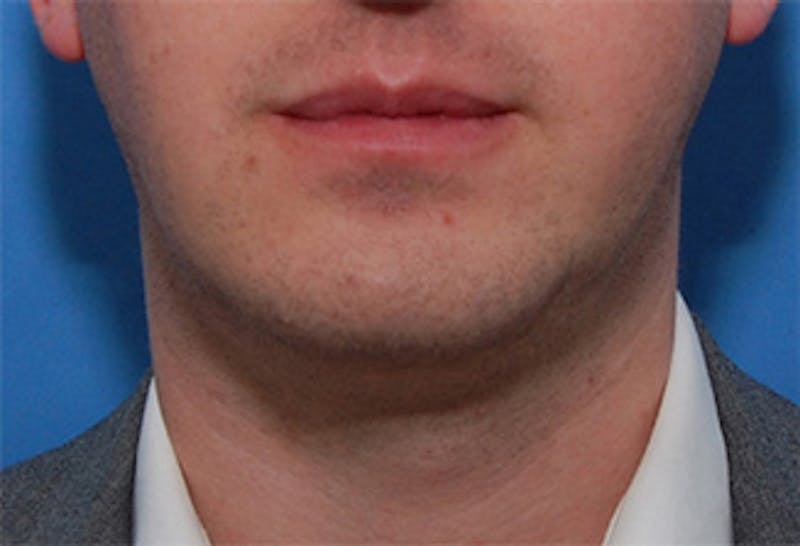 Fractora / Morpheus Before & After Gallery - Patient 279437 - Image 1