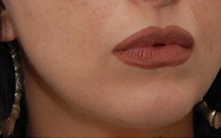 Chin Surgery Before & After Gallery - Patient 765705 - Image 4