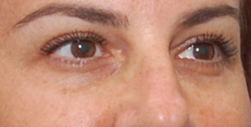 Eyelid Surgery Before & After Gallery - Patient 289046 - Image 4