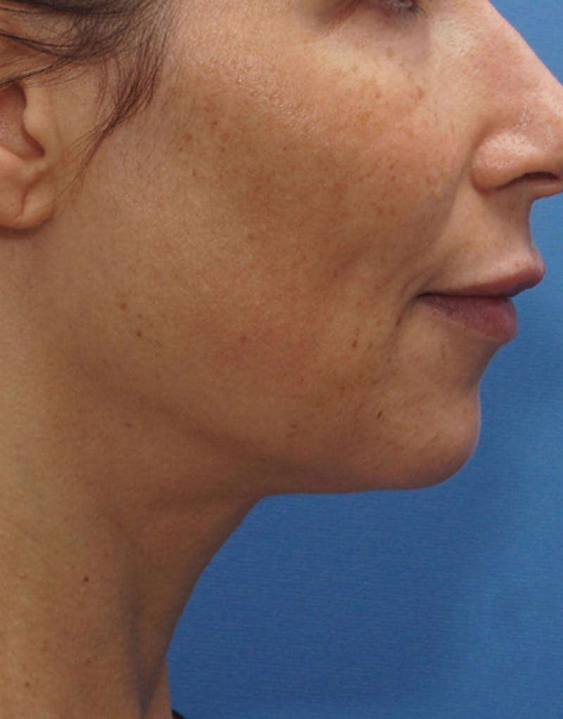 Jawline Contouring Before & After Gallery - Patient 395294 - Image 2