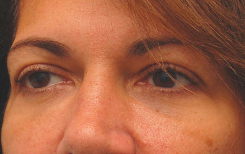 Fillers Before & After Gallery - Patient 229636 - Image 4