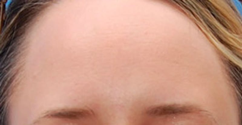 BOTOX Before & After Gallery - Patient 401532 - Image 2