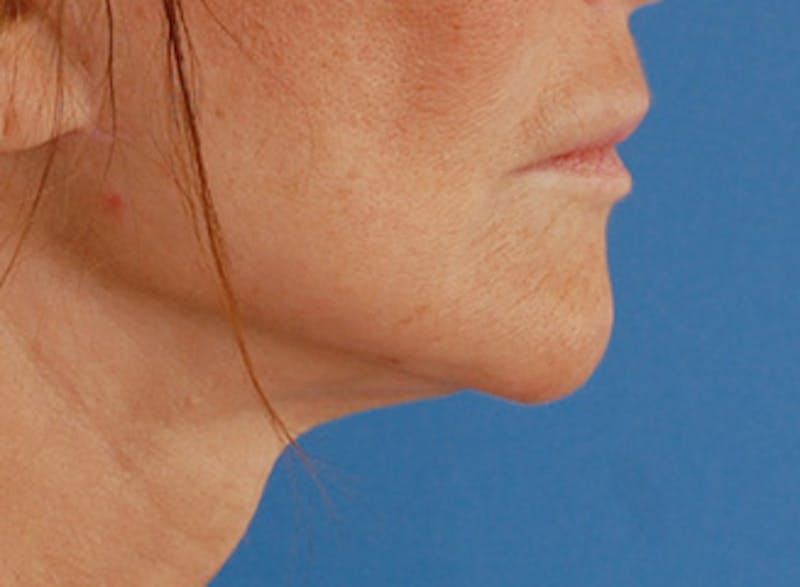 Facelift Before & After Gallery - Patient 192314 - Image 2