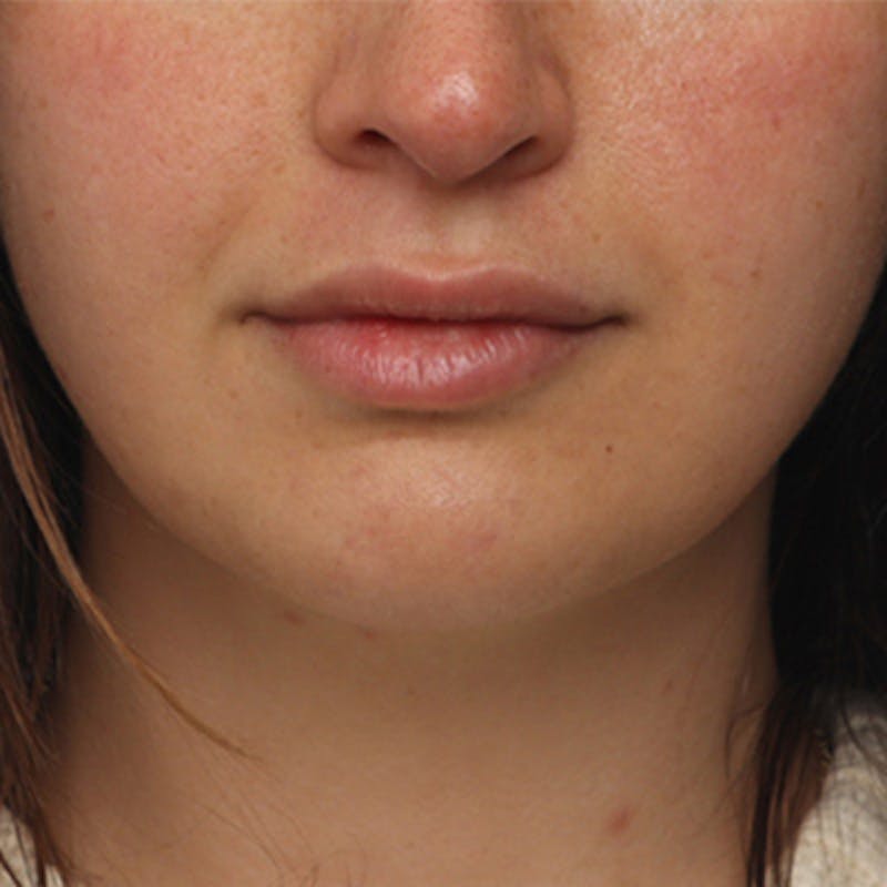 FaceTite Before & After Gallery - Patient 427549 - Image 2
