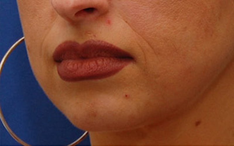 Chin Surgery Before & After Gallery - Patient 765705 - Image 5