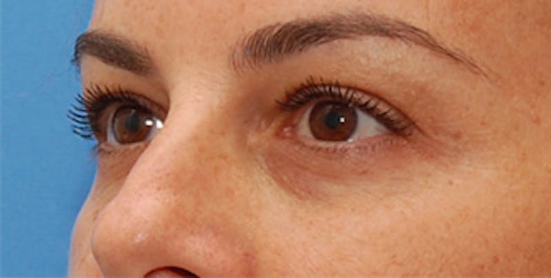 Eyelid Surgery Before & After Gallery - Patient 289046 - Image 5