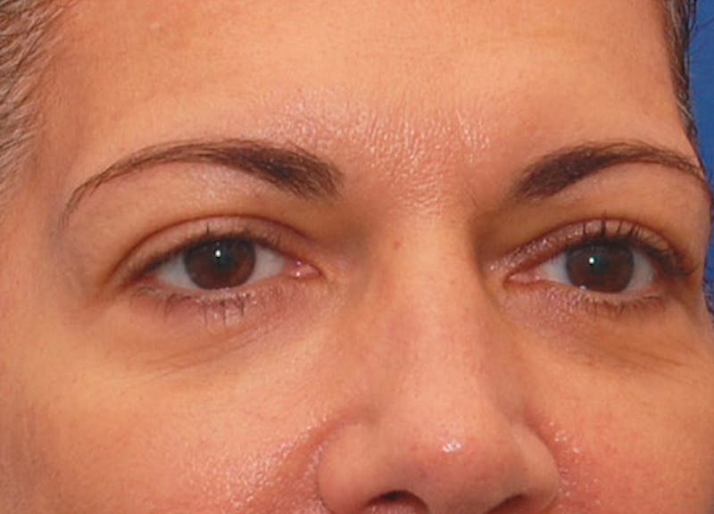 Fillers Before & After Gallery - Patient 229636 - Image 5