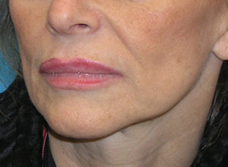 Facelift Before & After Gallery - Patient 192314 - Image 3