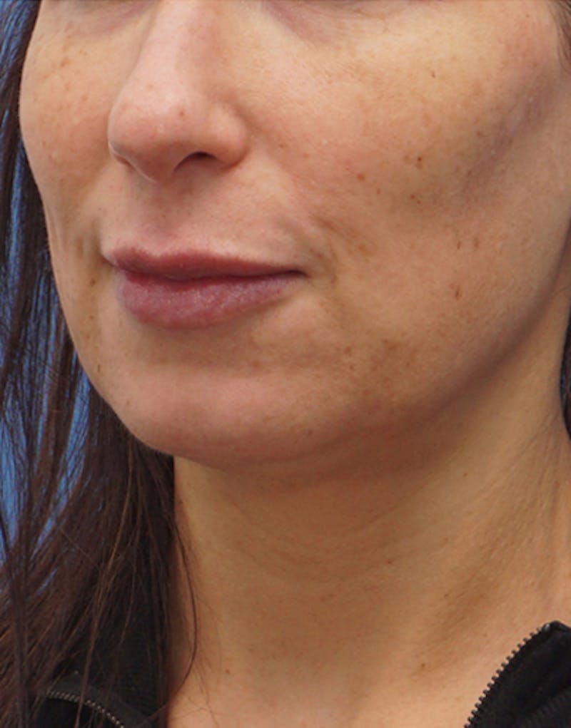 Jawline Contouring Before & After Gallery - Patient 395294 - Image 3