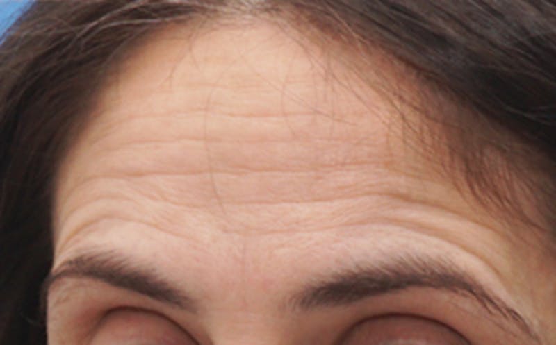 Patient PCWrf5Q5RRKik9T4haL_qA - BOTOX Before & After Photos