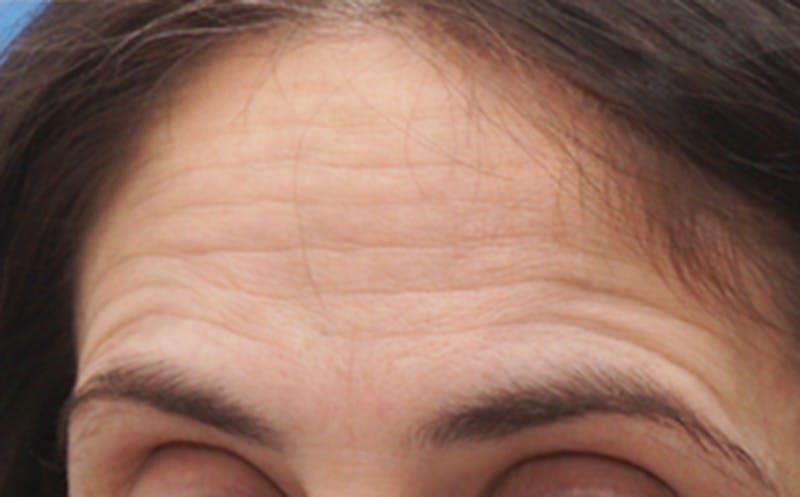 BOTOX Before & After Gallery - Patient 382021 - Image 1