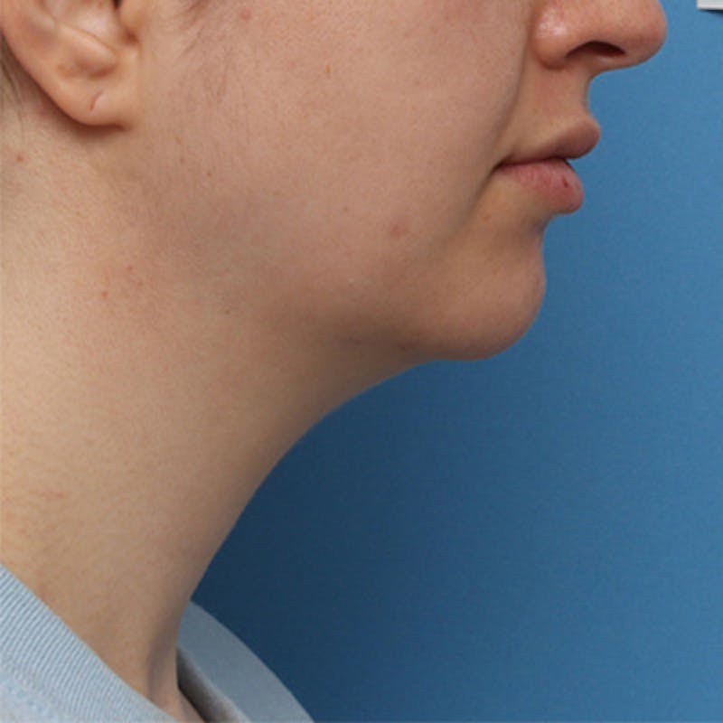 FaceTite Before & After Gallery - Patient 427549 - Image 3