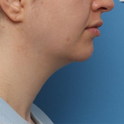FaceTite Before & After Gallery - Patient 427549 - Image 1