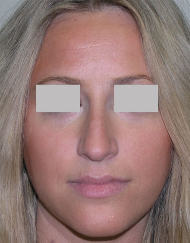 Rhinoplasty Before & After Gallery - Patient 826491 - Image 3