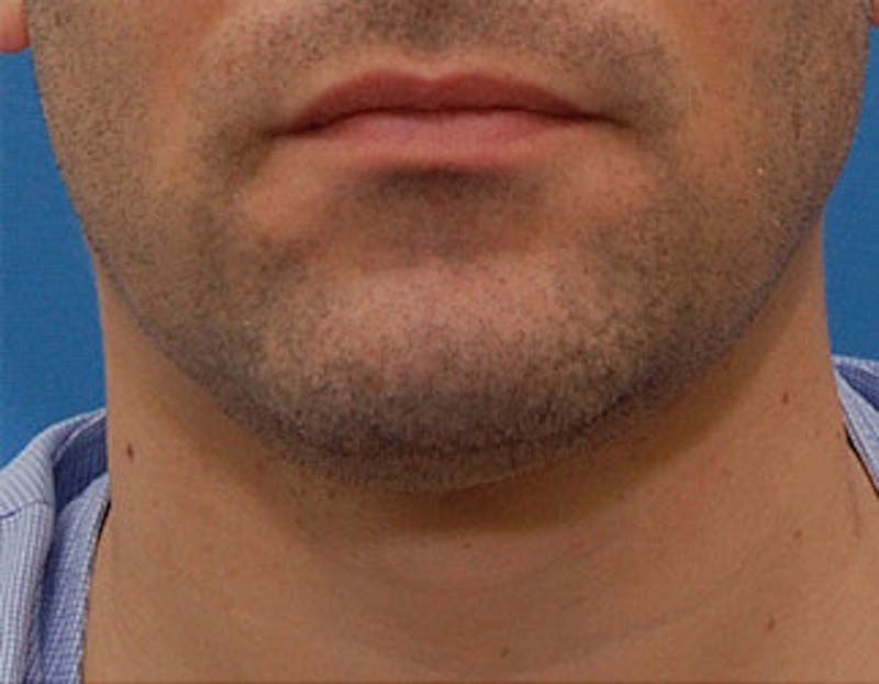 Kybella Before & After Gallery - Patient 144039 - Image 1