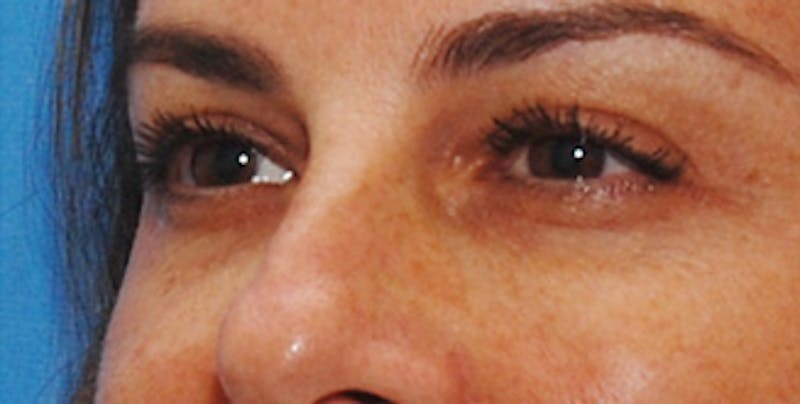 Eyelid Surgery Before & After Gallery - Patient 289046 - Image 6