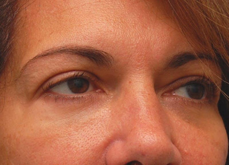Fillers Before & After Gallery - Patient 229636 - Image 6