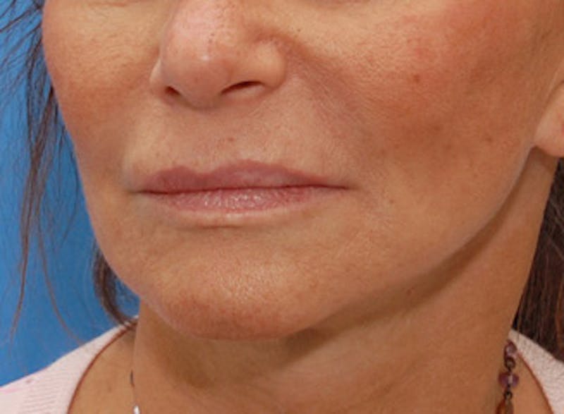 Facelift Before & After Gallery - Patient 192314 - Image 4