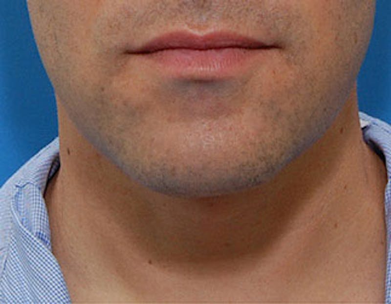 Kybella Before & After Gallery - Patient 144039 - Image 2