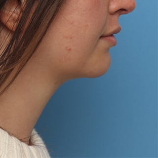 FaceTite Before & After Gallery - Patient 427549 - Image 2