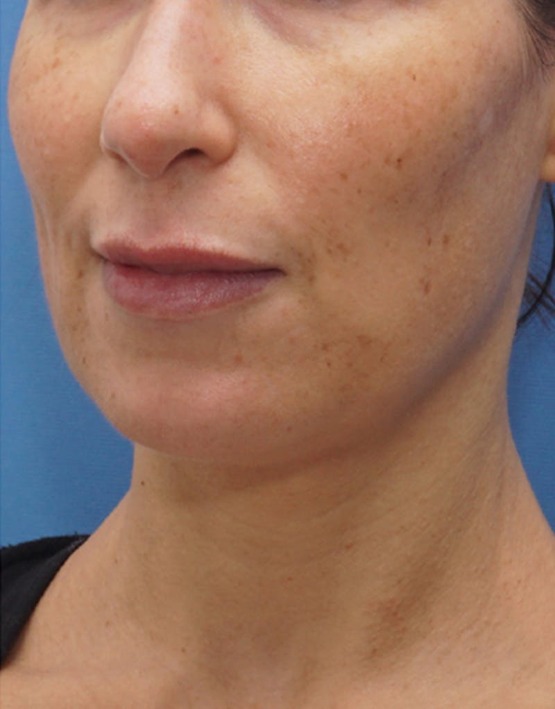 Jawline Contouring Before & After Gallery - Patient 395294 - Image 4