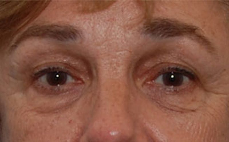 Patient dNVz4dDnSQ-3DK0at1eU7w - Eyelid Surgery Before & After Photos