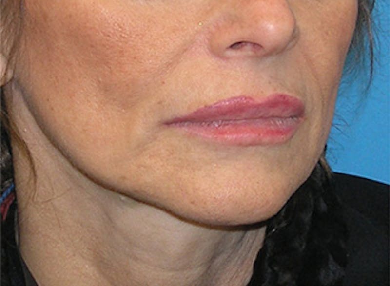 Facelift Before & After Gallery - Patient 192314 - Image 5