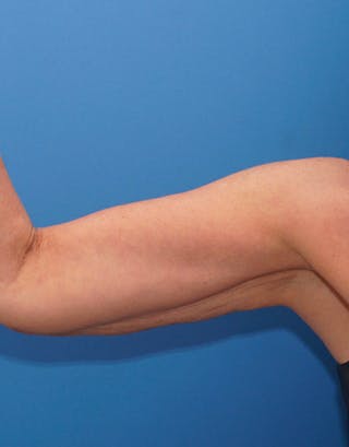 BodyTite Before & After Gallery - Patient 220852 - Image 8