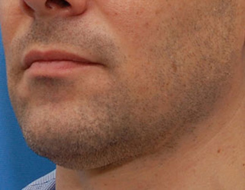 Kybella Before & After Gallery - Patient 144039 - Image 3