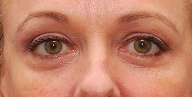 Patient WpejuVP1Tz6qrONxTpG_xQ - BOTOX Before & After Photos