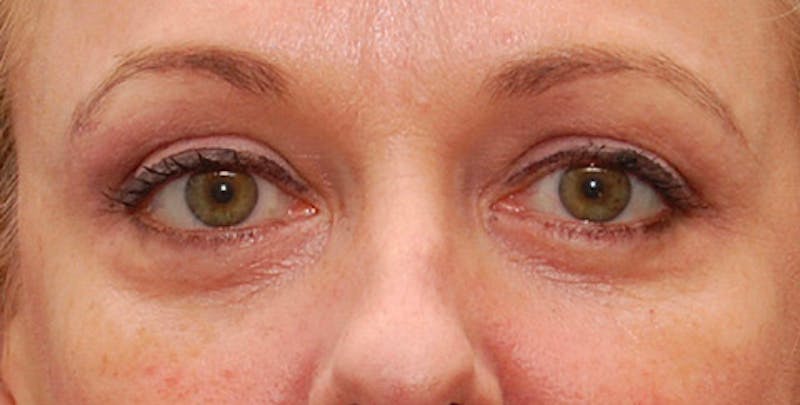 Fillers Before & After Gallery - Patient 201225 - Image 1