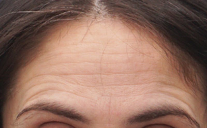 BOTOX Before & After Gallery - Patient 382021 - Image 3