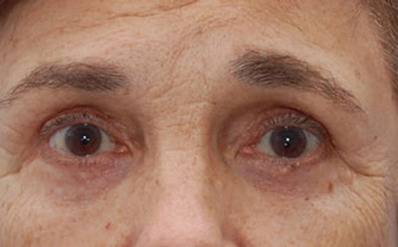 Eyelid Surgery Before & After Gallery - Patient 133362 - Image 2