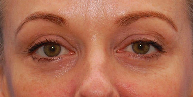 Fillers Before & After Gallery - Patient 201225 - Image 2