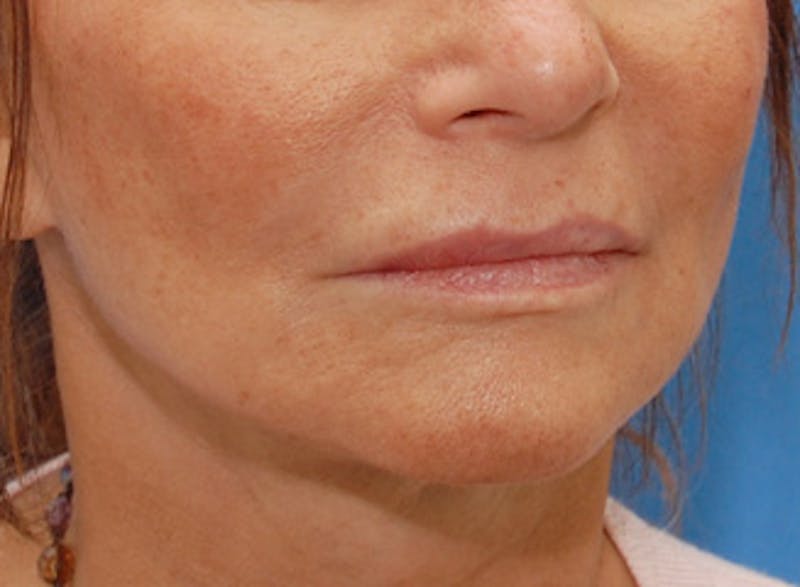 Facelift Before & After Gallery - Patient 192314 - Image 6
