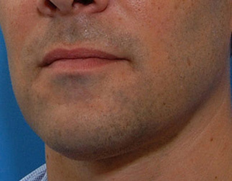 Kybella Before & After Gallery - Patient 144039 - Image 4