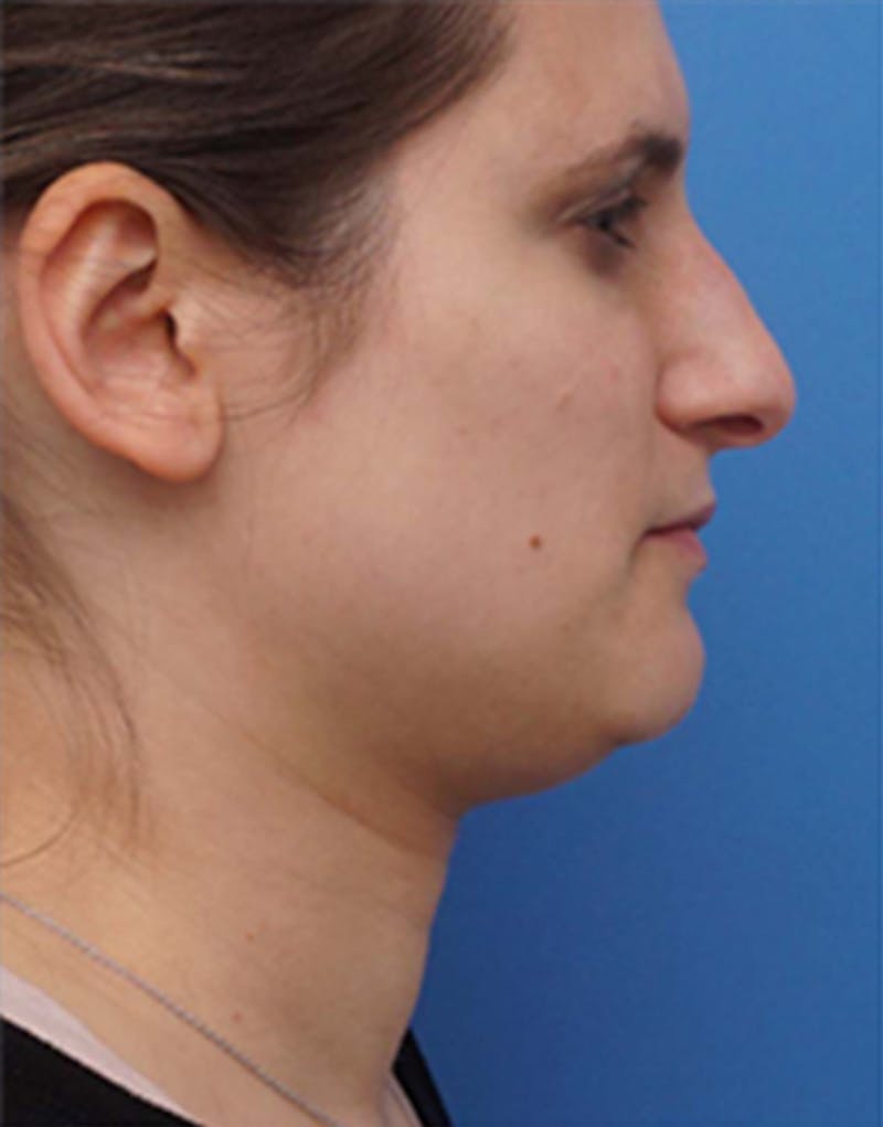 Patient Zz56XEXUTUOmtqwMZOvJOw - Jawline Contouring Before & After Photos