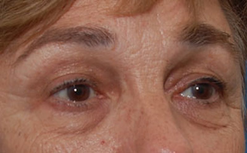 Eyelid Surgery Before & After Gallery - Patient 133362 - Image 3