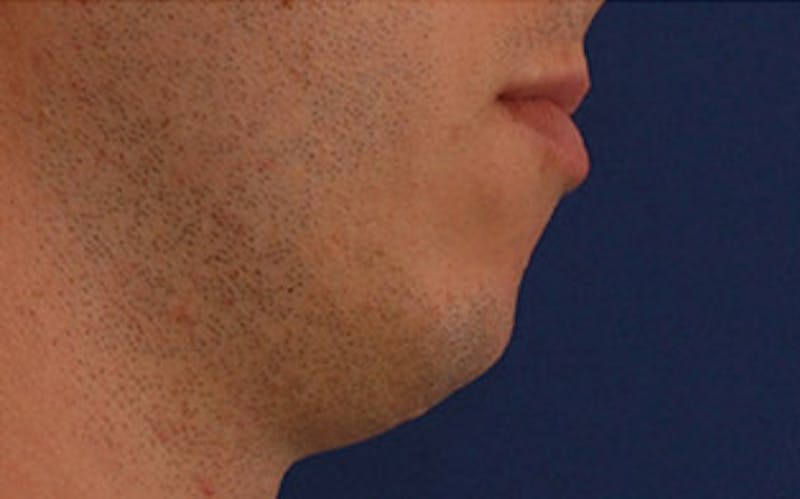 Chin Surgery Before & After Gallery - Patient 259350 - Image 1