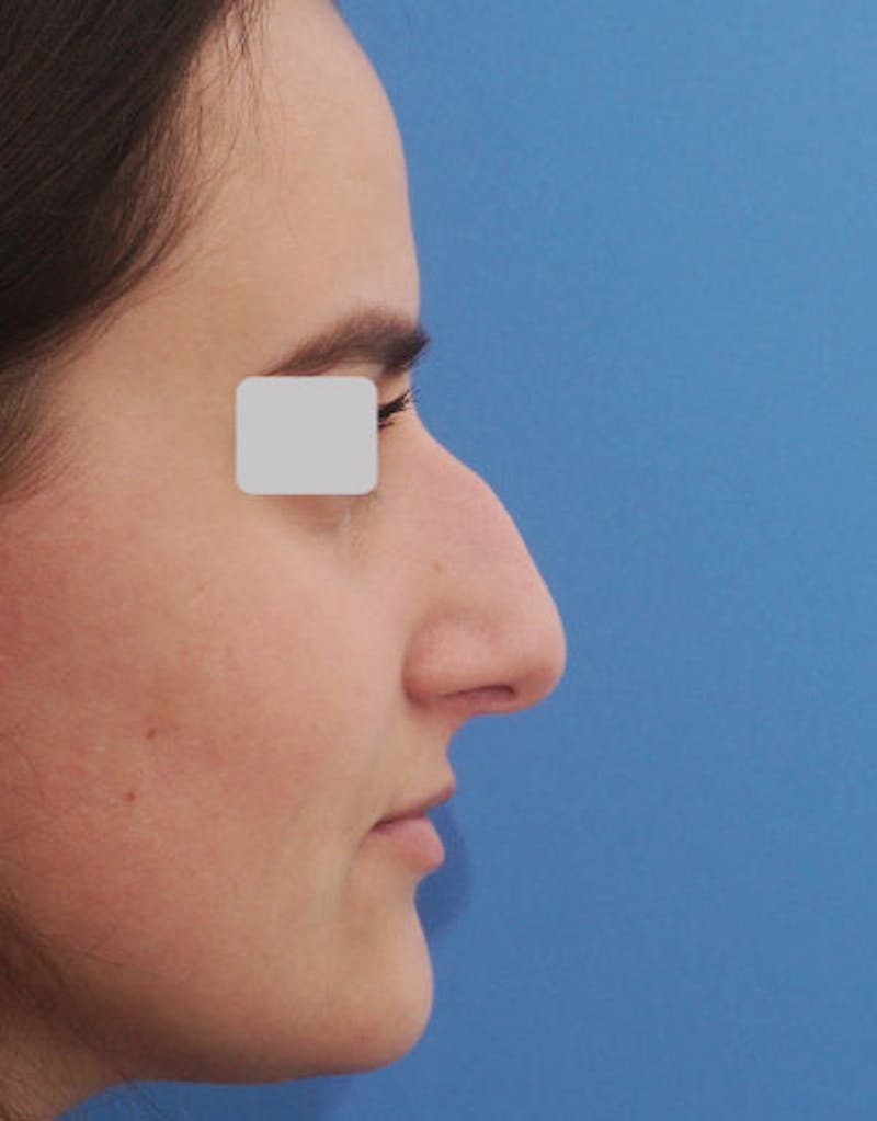 Rhinoplasty Before & After Gallery - Patient 303287 - Image 1